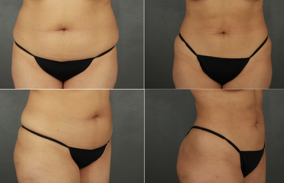 Пациентка пластического хирурга Амрама Пайтяна до и после липосакции