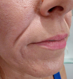 Носогубные складки