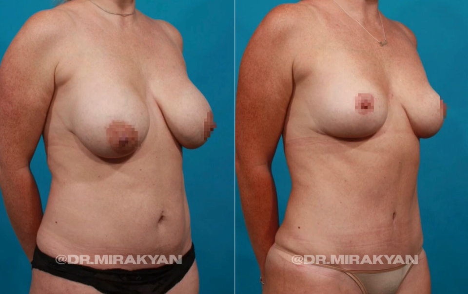 Пациентка пластического хирурга Гукаса Миракяна до и после одновременной пластики груди и живота