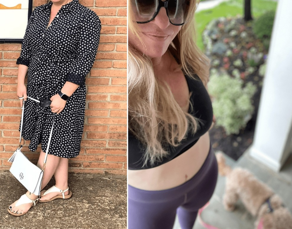 Фото до и после абдоминопластики живота