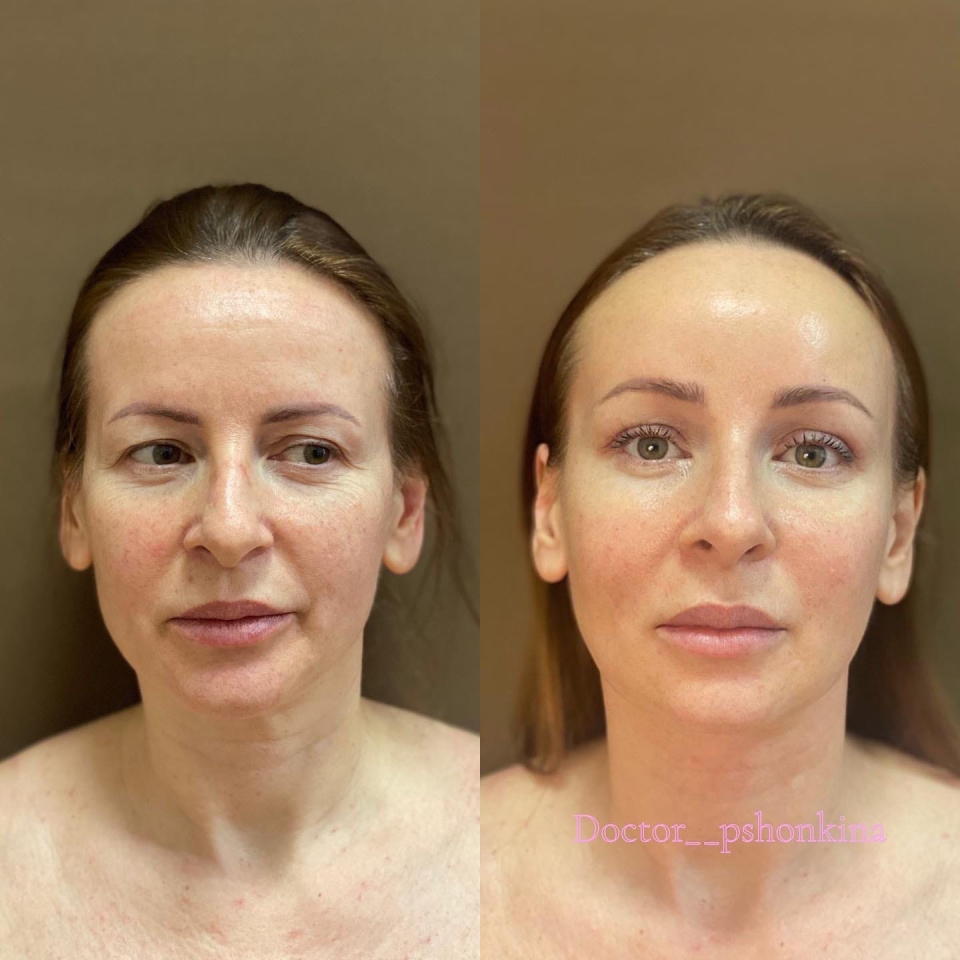 Пациентка пластического хирурга Светланы Пшонкиной до и после подтяжки лица