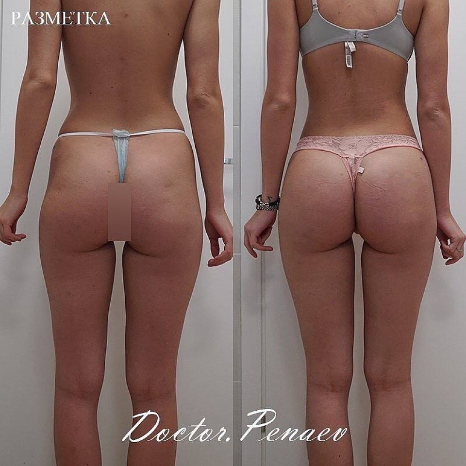 Пациентка пластического хирурга Арслана Пенаева до и после VASER-липосакции тела