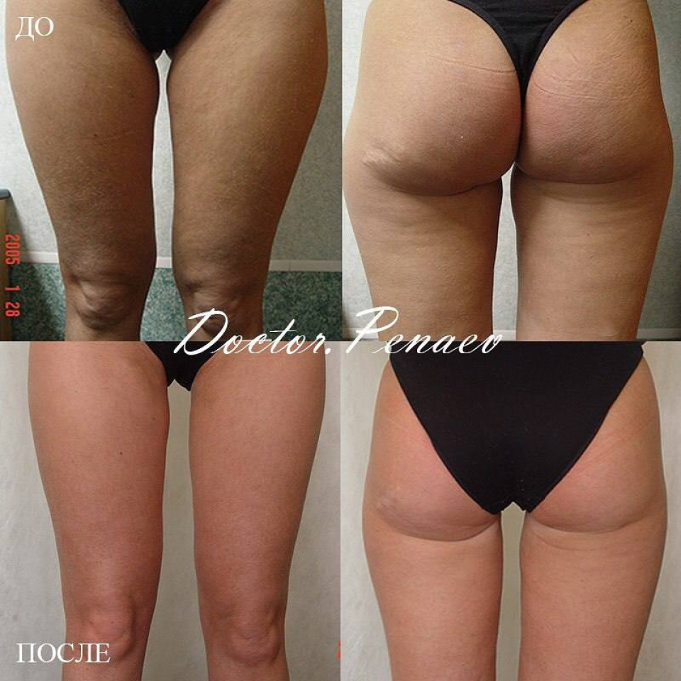 Пациентка (48 лет) пластического хирурга Арслана Пенаева до и после VASER-липосакции бедер и коленок