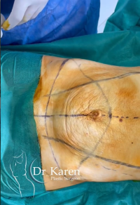 Так выглядел живот пациентки прямо перед абдоминопластикой