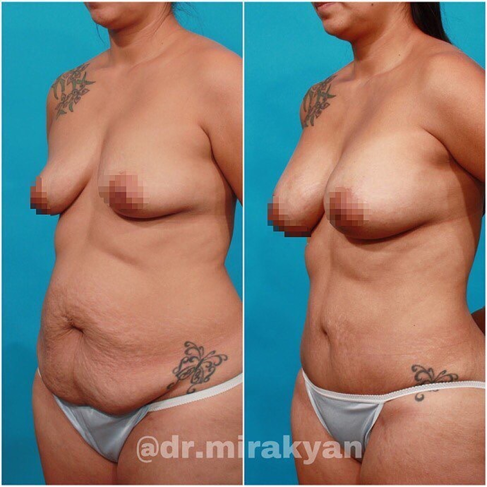 Пациентка пластического хирурга Гукаса Миракяна до и после увеличения груди и подтяжки живота.