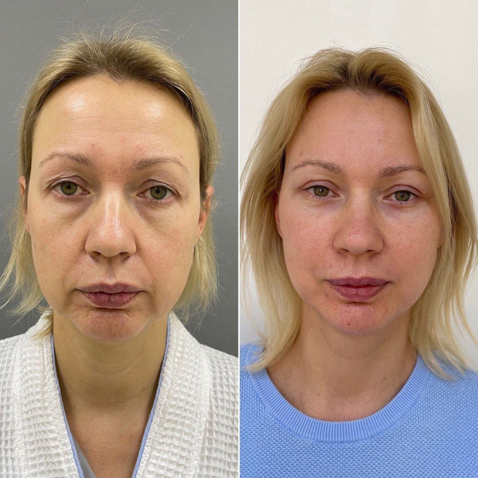 Пациентка пластического хирурга Марины Четвериковой до и после комплексного омоложения лица и шеи