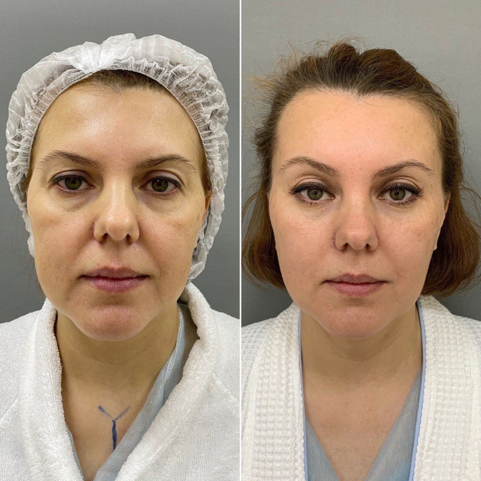 Пациентка пластического хирурга Марины Четвериковой до и после комплексного омоложения лица