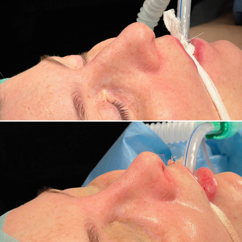 Пациентка пластического хирурга Валерия Стайсупова до и после закрытой риносептопластики