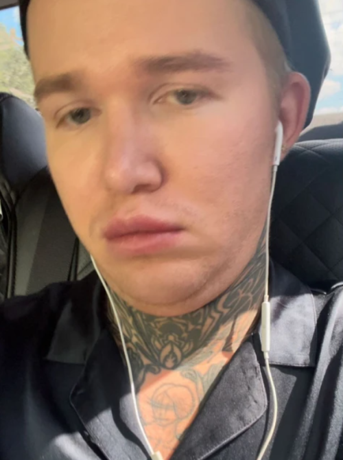 Федор Швец лишился работы после липосакции лица