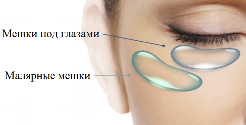 Разница между мешками под глазами и малярными мешками.