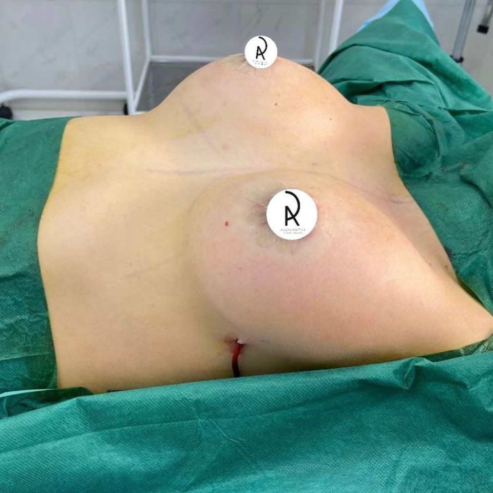Пациентка пластического хирурга Амрама Пайтяна после увеличения груди имплантами