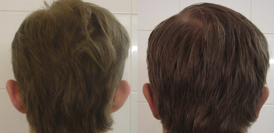 Пациент пластического хирурга Валерия Стайсупова до и после пластики ушей