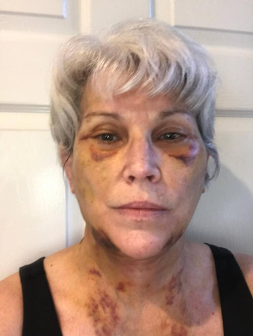 Cиняки после подтяжки лица