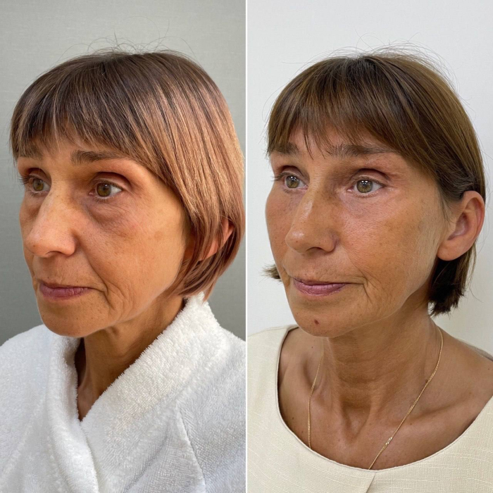 Пациентка пластического хирурга Марины Четвериковой до и после комплексной омолаживающей операции в Санкт-Петербурге