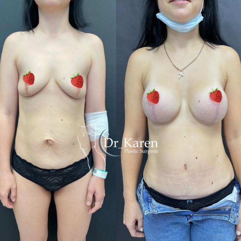 Пациентка пластического хирурга Карена Пайтяна до и после операции ПостНатал