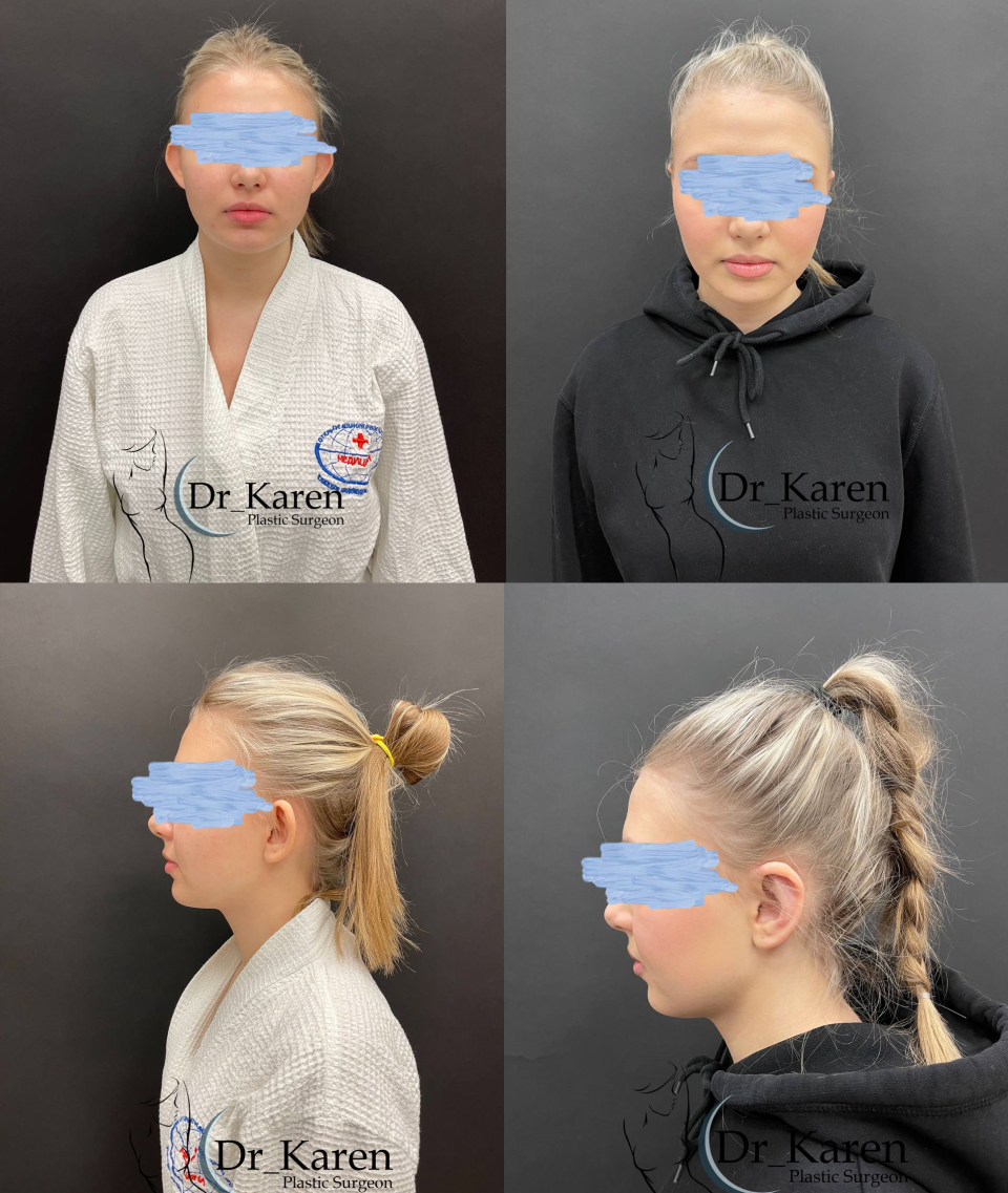 Пациентка пластического хирурга Карена Пайтяна до и после отопластики