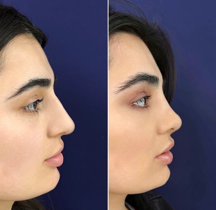 Пациентка до и после ринопластики у пластического хирурга Паруйра Минасяна