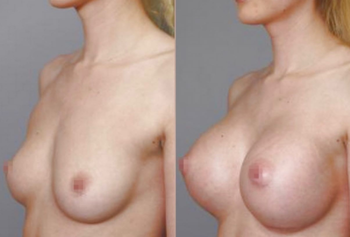 Пациентка до и после увеличения груди у пластического хирурга Паруйра Минасяна