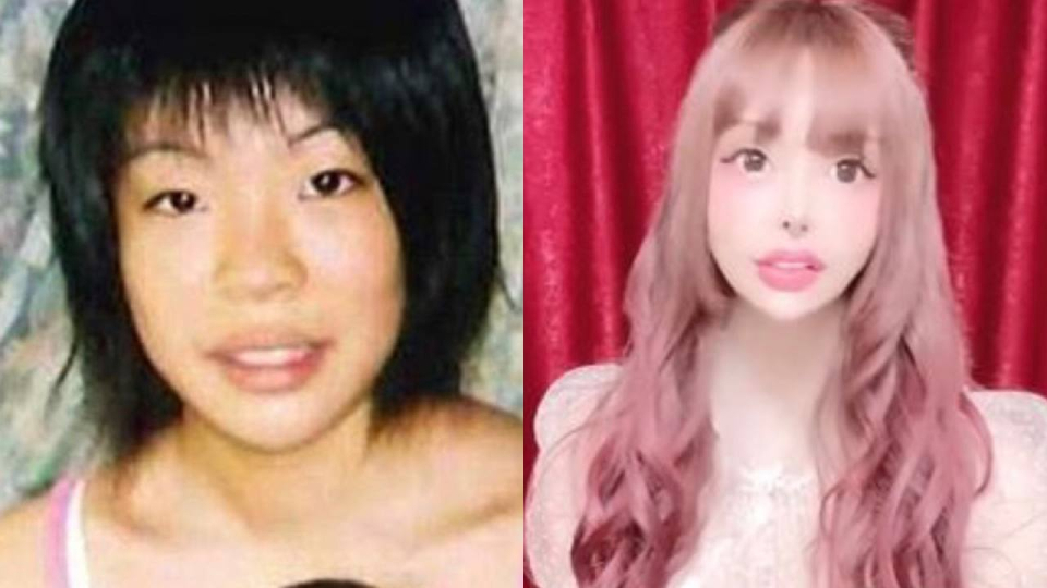 Блогер до и после пластических операций