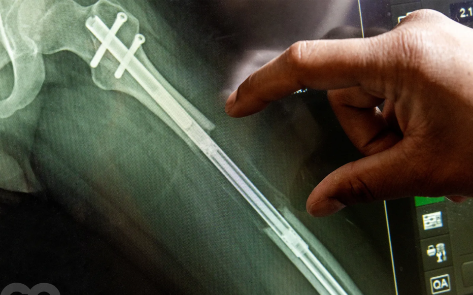 Врач разработал метод имплантации и последующего удлинения штифтов в бедренной кости