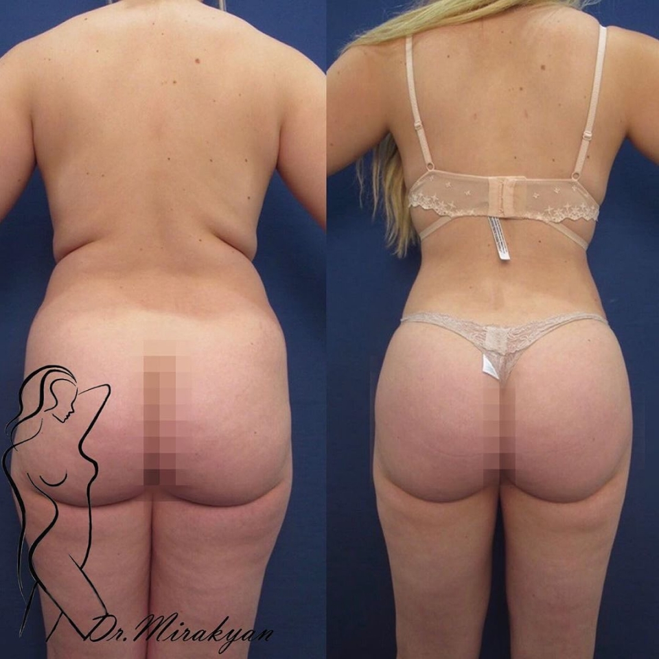 Пациентка доктора Гукаса Миракяна до и после увеличения ягодиц с помощью липофилинга.
