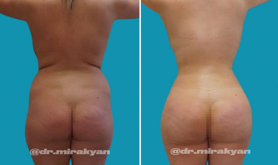 Пациентка доктора Гукаса Миракяна до и после увеличения ягодиц с помощью липофилинга