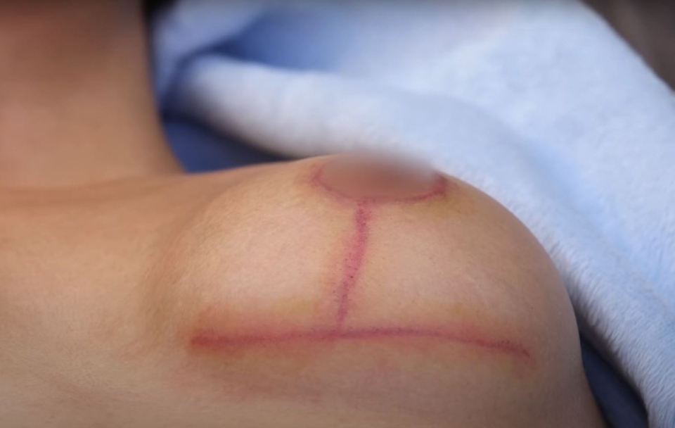 Так выглядят заживающие разрезы после операции по уменьшению груди