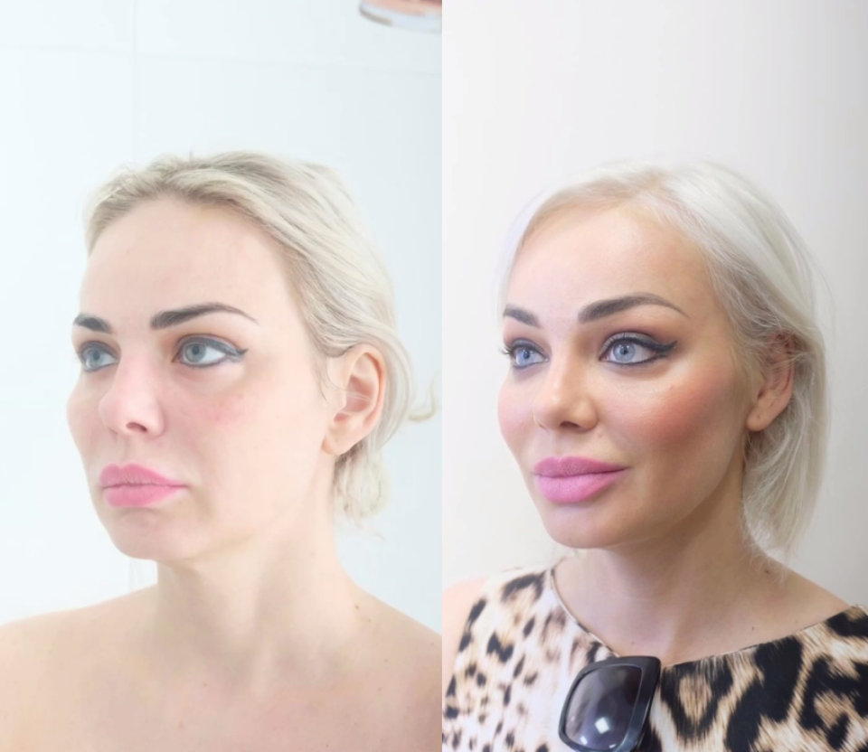 Фото до и после эндоскопической подтяжки лица. Пациентка московского пластического хирурга Светланы Пшонкиной