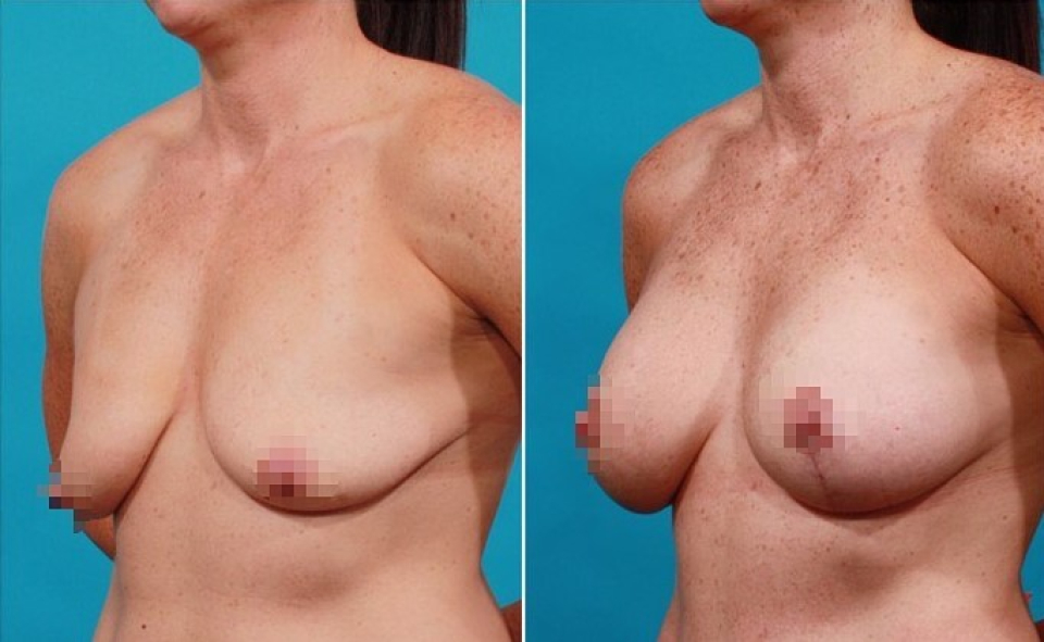 Пациентка доктора Гукаса Миракяна до и после подтяжки груди с увеличением