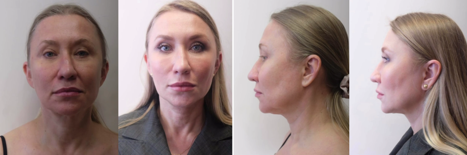 Пациентка доктора Пшонкиной до и после нитевого лифтинга, фейс тайт подбородка и фракторы