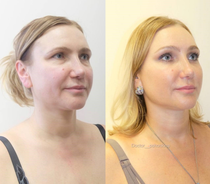 Пациентка пластического хирурга Светланы Пшонкиной до и после эндоскопической операции