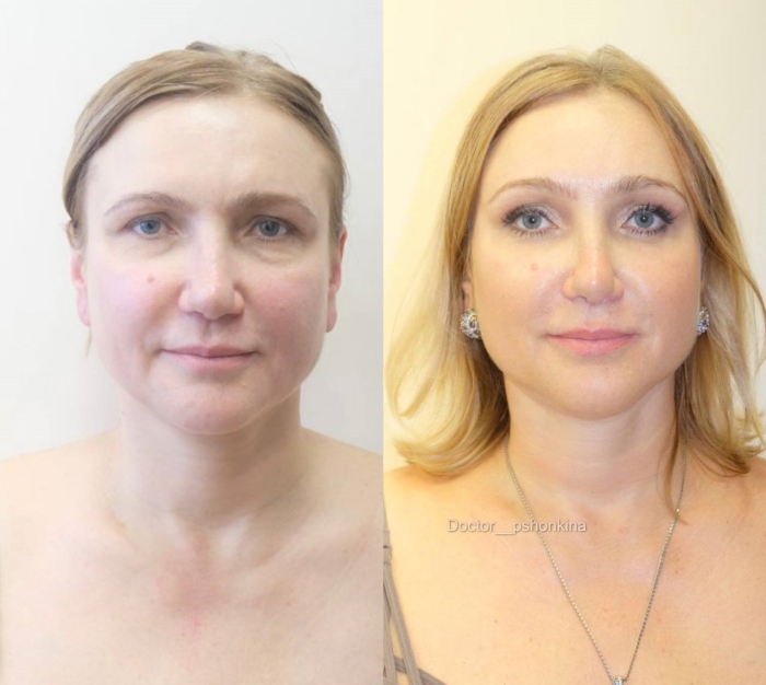 Пациентка пластического хирурга Светланы Пшонкиной до и после вторичной омолаживающей операции