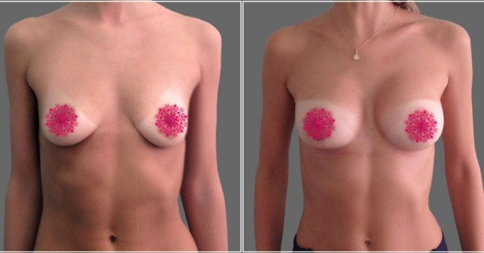 Пациентка пластического хирурга Дмитрия Рябцева до и после увеличения груди имплантами