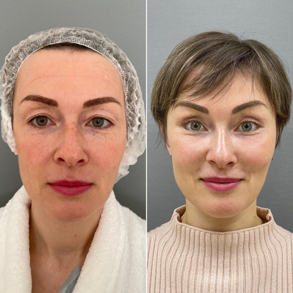 Пациентка пластического хирурга Марины Четвериковой до и после эндоскопического омоложения лица.