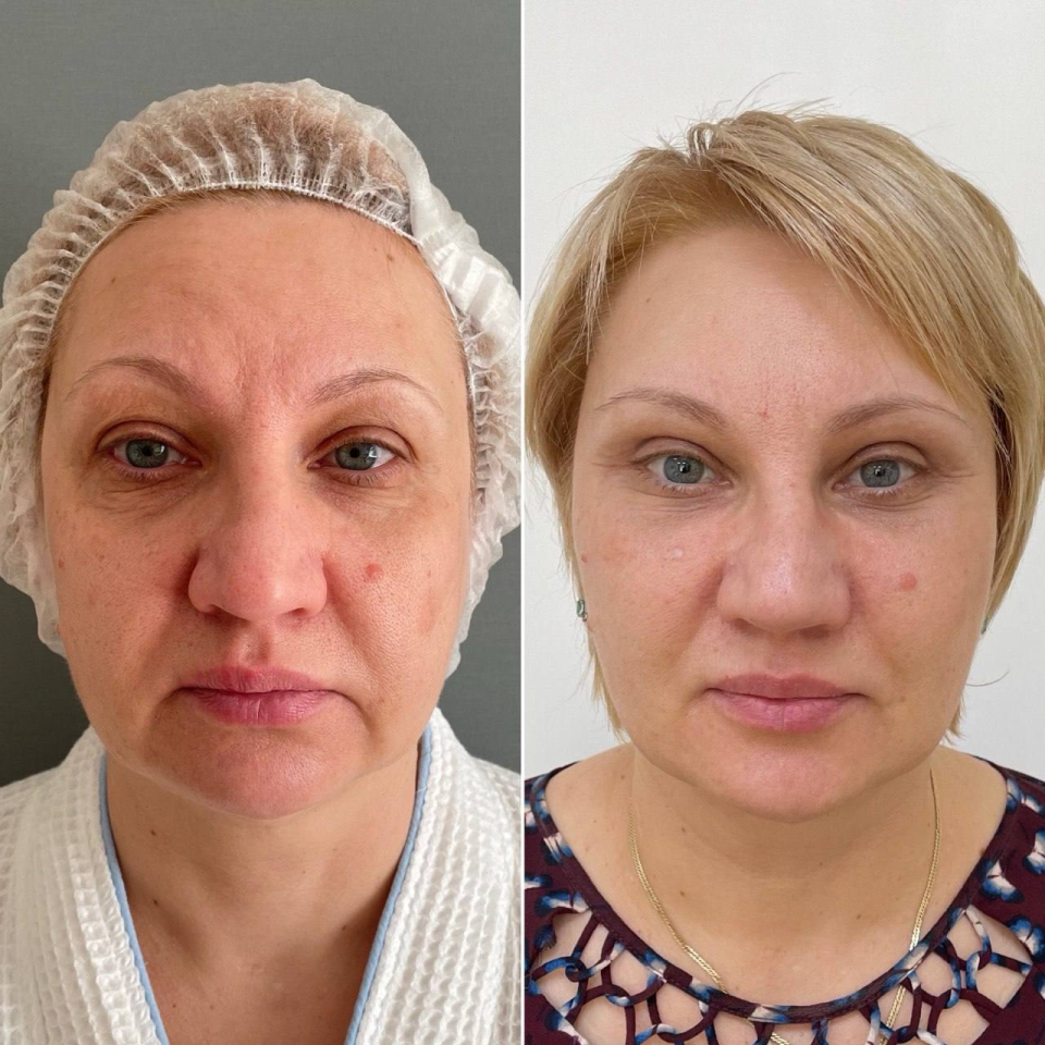 Пациентка пластического хирурга Марины Четвериковой до и после комплексного эндоскопического омоложения лица.
