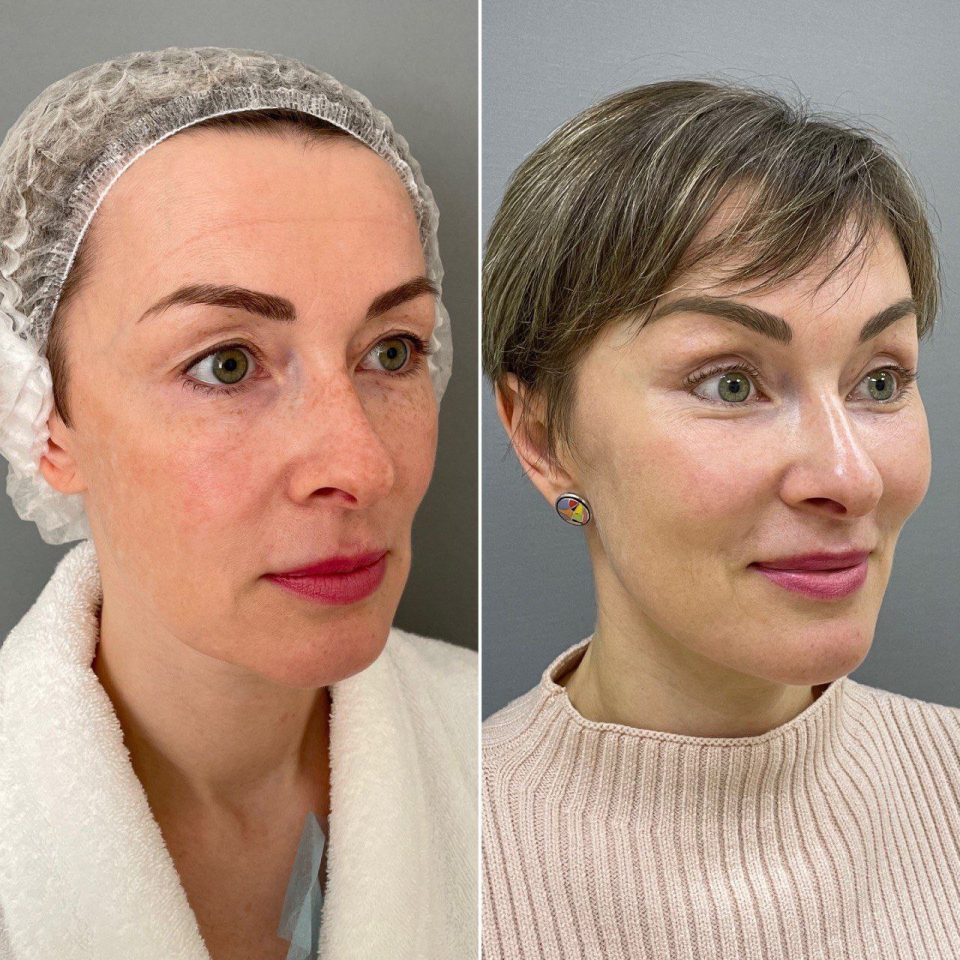 Пациентка пластического хирурга Марины Четвериковой до и после эндоскопического омоложения лица в Санкт-Петербурге