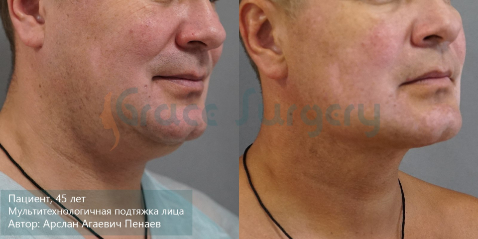 Пациент пластического хирурга Арслана Пенаева. Фото до и после мультитехнологичного малоинвазивного лифтинга лица (М2Л2)