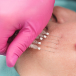 Минимально инвазивные варианты подтяжки лица