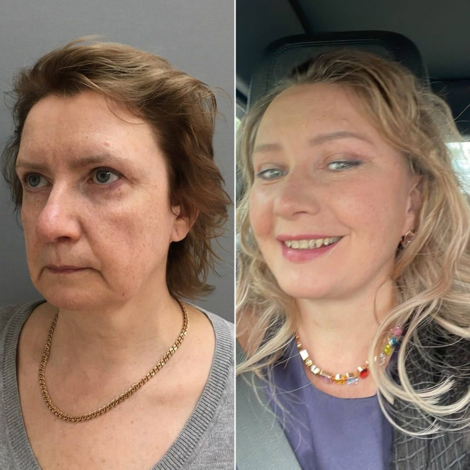 Пациентка пластического хирурга Марины Четвериковой до и спустя 2,5 года после комплексного омоложения лица.