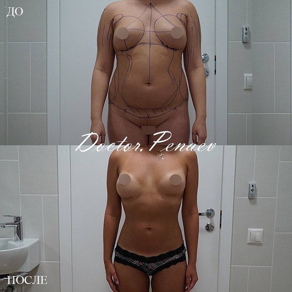 Пациентка (33 года) пластического хирурга Арслана Пенаева до и после вазер липосакции
