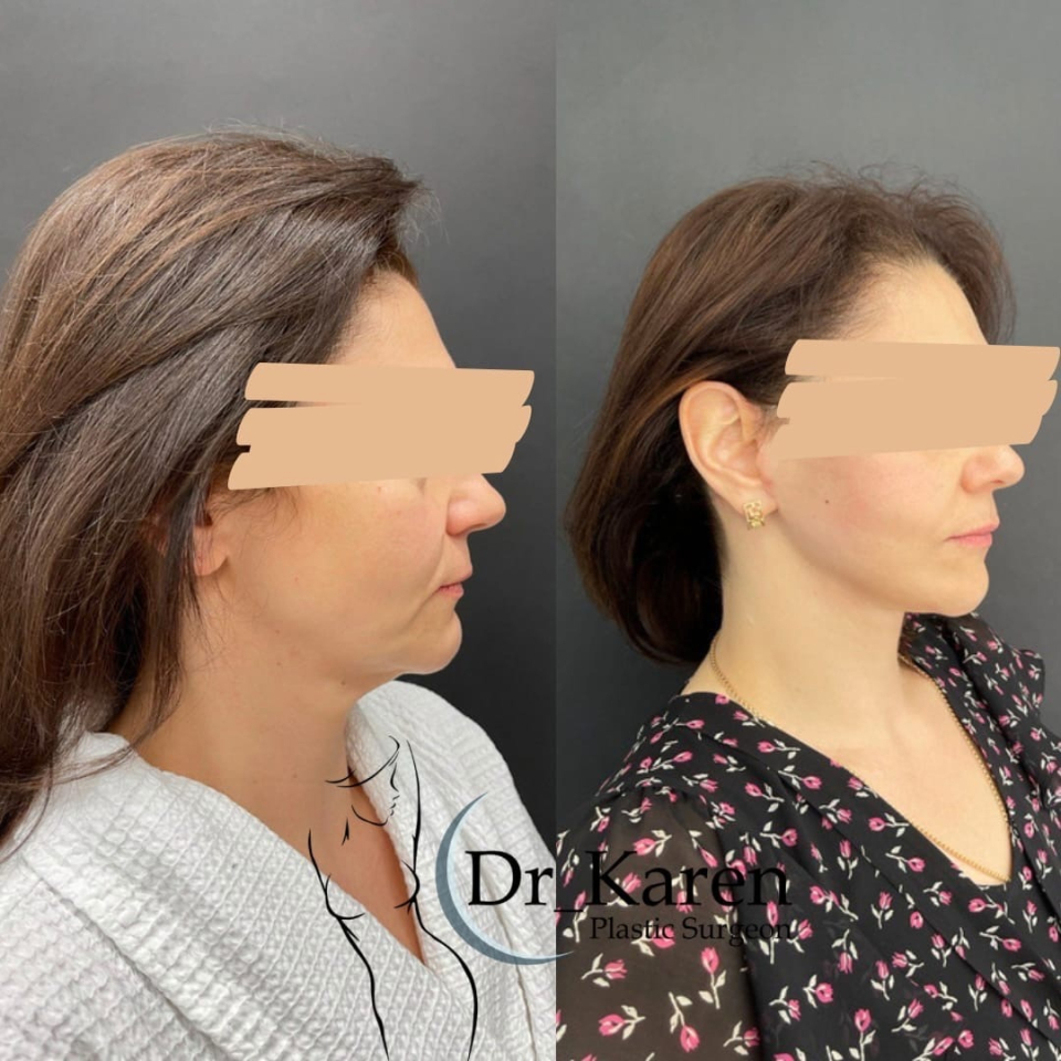 Пациентка пластического хирурга Карена Пайтяна. Фото до и после SMAS-подтяжки лица в Москве