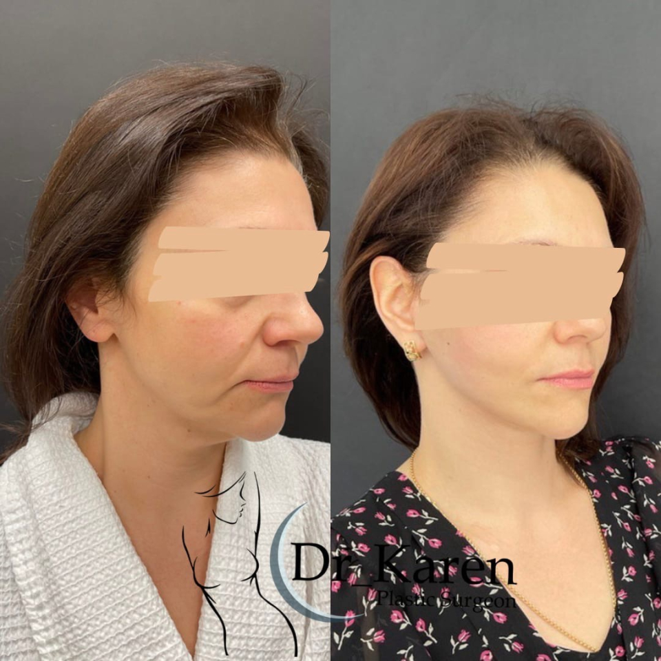 Пациентка пластического хирурга Карена Пайтяна. Фото до и после SMAS-подтяжки лица