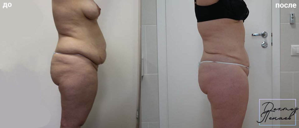 Пациентка (42 года) пластического хирурга Арслана Пенаева. Фото до и после абдоминопластики