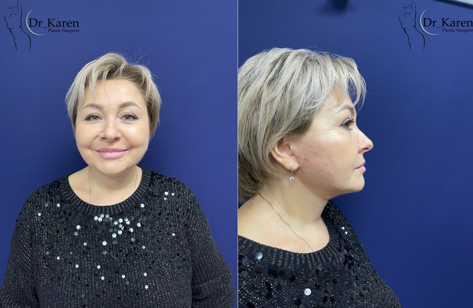 Пациентка пластического хирурга Карена Пайтяна после СМАС-подтяжки лица