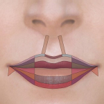Хирургическая подтяжка губ или филлеры