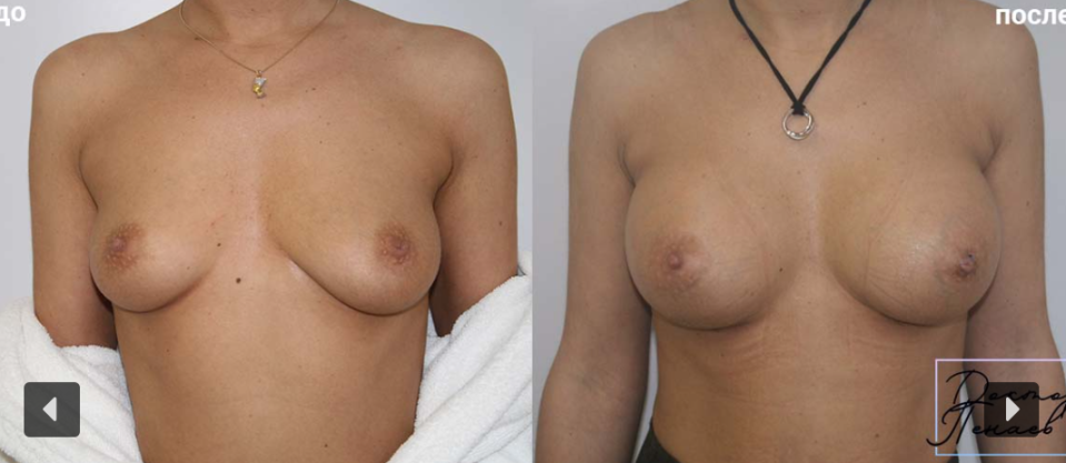 Пациентка пластического хирурга Арслана Пенаева до и после увеличения груди. Импланты: круглые 285 мл.