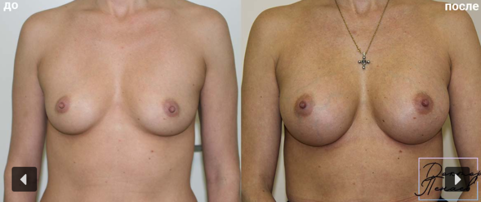Пациентка пластического хирурга Арслана Пенаева до и после увеличения груди. Импланты: круглые 300 СС.