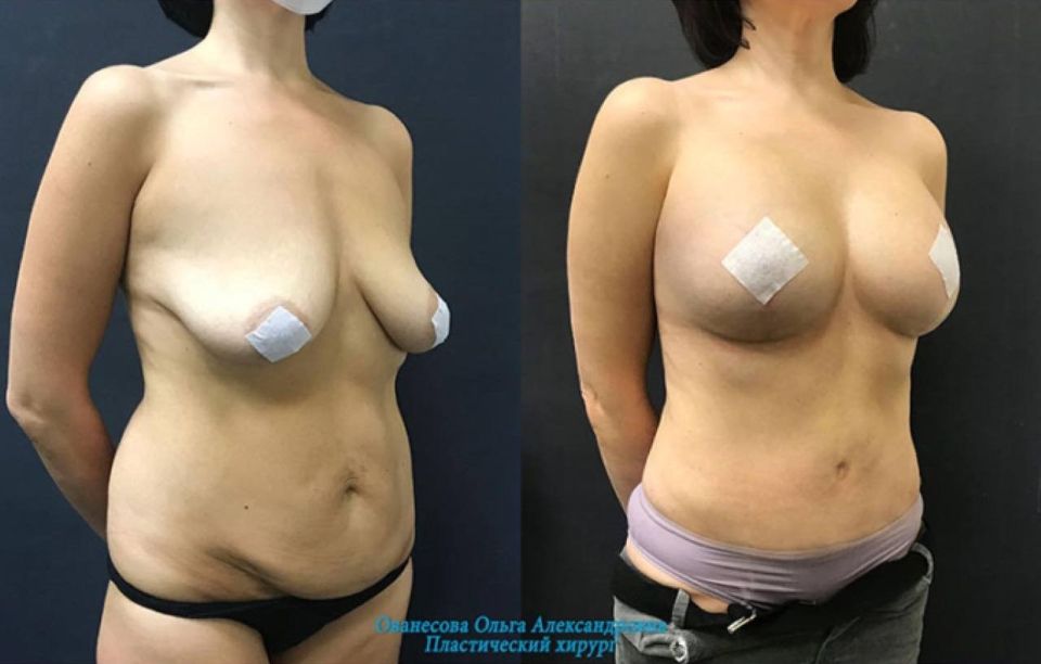 Пациентка пластического хирурга Ольги Ованесовой после комплексной коррекции тела
