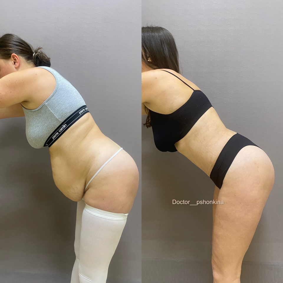 Пациентка доктора Светланы Пшонкиной до и после абдоминопластики