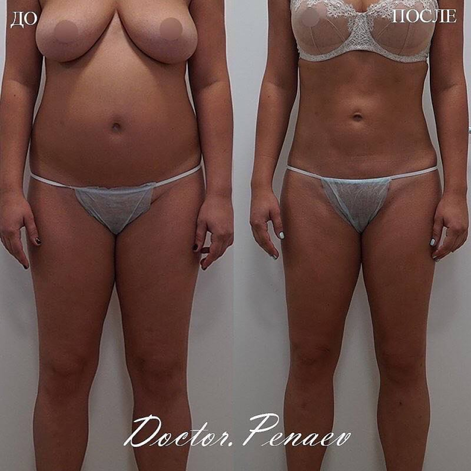 Пациентка (31 год) пластического хирурга Арслана Пенаева до и после бодидизайна